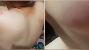 Hendek Yeşilköyde Sivrisineklerin ısırdığı Genç Hastanelik Oldu 